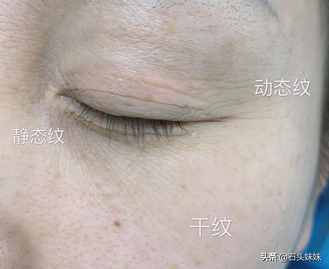 淡化眼纹黑眼圈的方法,女人眼睛看起来很显老要怎样调理