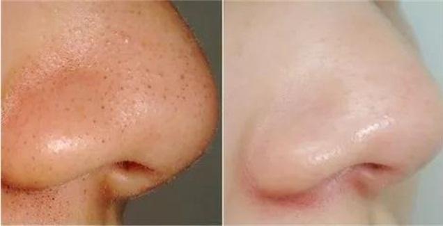 牙膏去黑头的方法靠谱吗,牙膏去黑头的正确方法