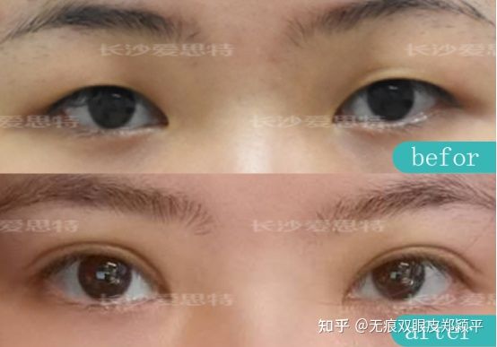 割双眼皮几毫米最好看,割双眼皮真的会好看吗
