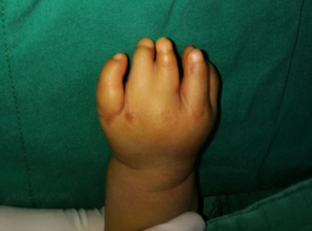 并指畸形免植皮案例,并指畸形