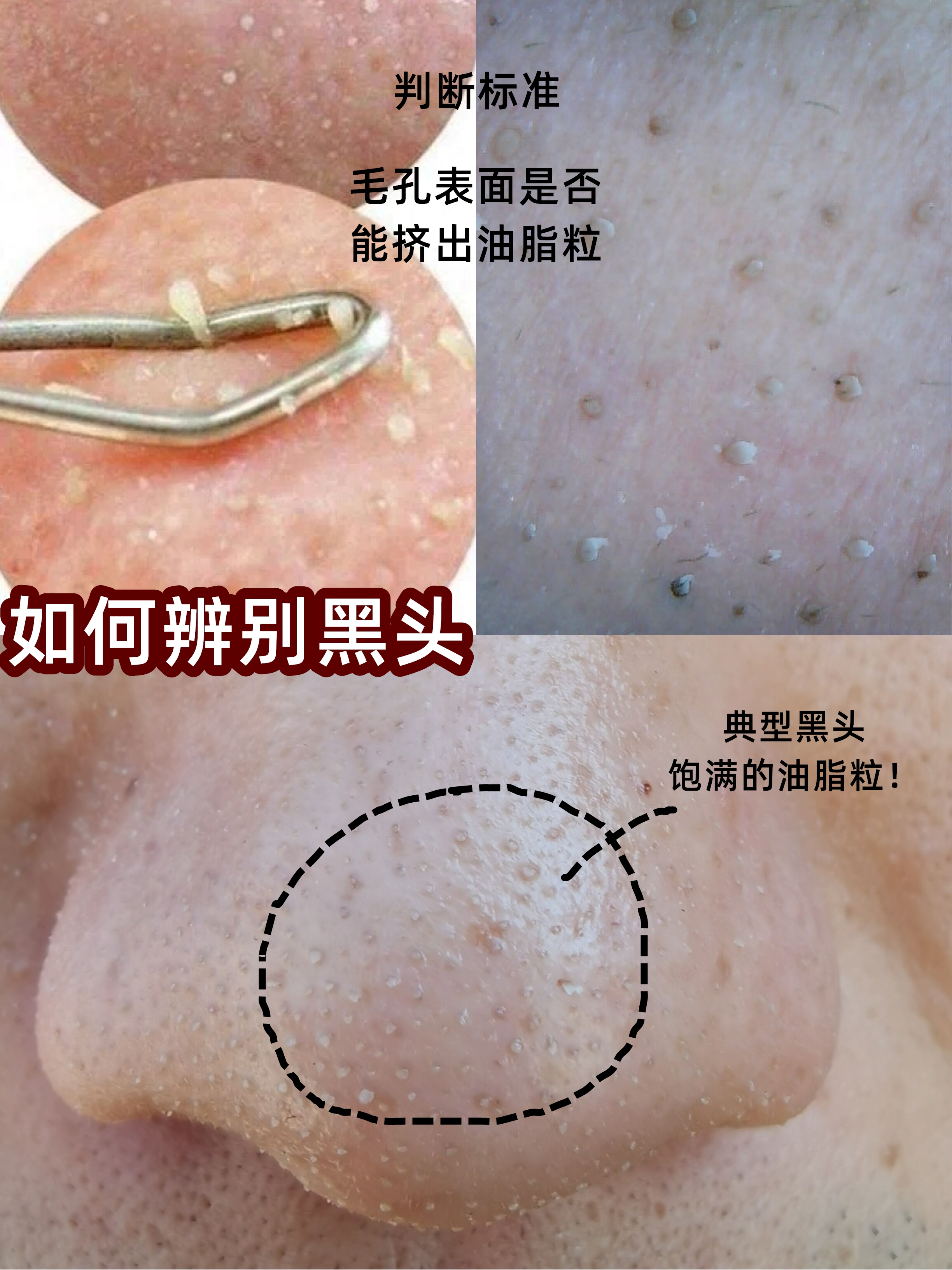 黑头如果不管的话会怎样,如果黑头一直不挤会怎样