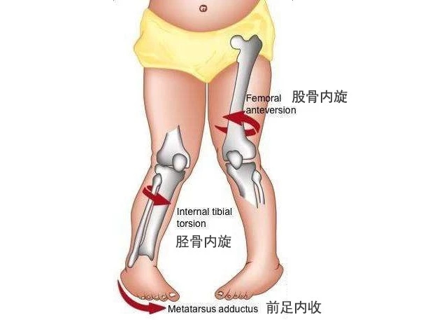 幼儿走路内八字鞋子反着穿可以吗,孩子走路内八与穿鞋有关系吗
