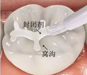 一个月宝宝口腔上颚白色的是什么,婴儿口腔上颚有一个小米样的白点