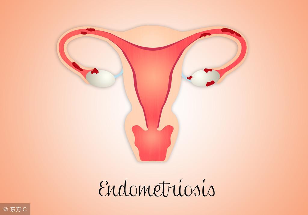 宫颈炎是怎样的,宫颈炎如何引起的