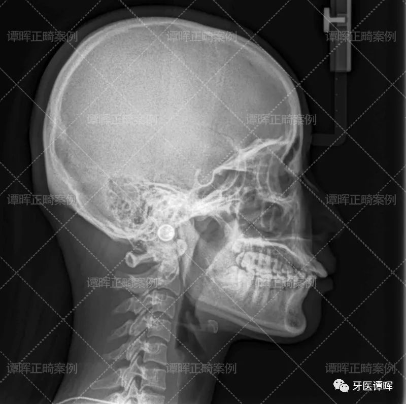 门牙前突牙齿不齐矫正案例分享,门牙和旁边牙齿不齐最快矫正方法