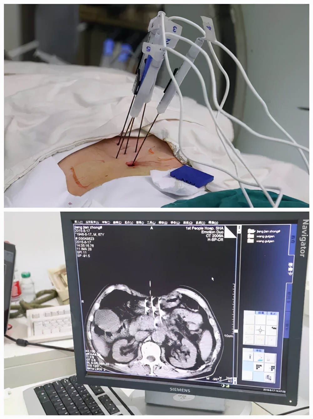 上海市一医院肿瘤中心施行沪上首例“纳米刀”治疗胰腺癌手术