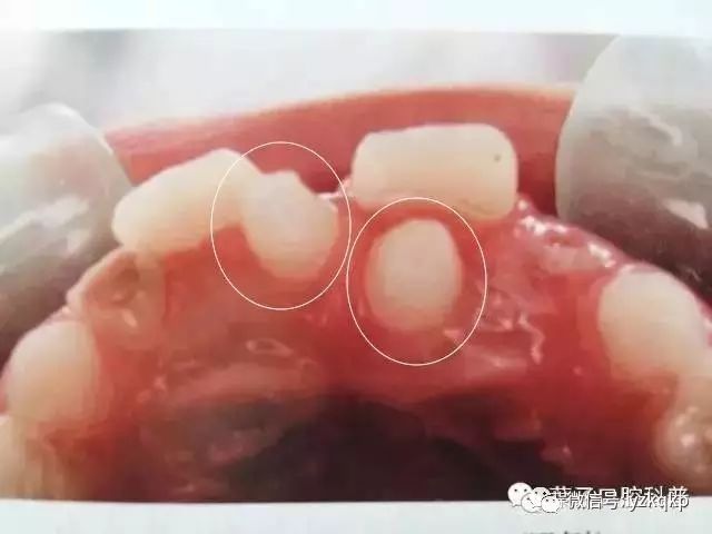 孩子多余的牙齿什么年龄适合拔掉,小孩子的牙齿需要填补吗