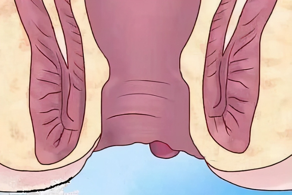 肛门处总长小肉球肉疙瘩怎么回事,肛门长小肉球肉疙瘩是怎么了