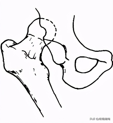 夏天无注射液能治疗骨头坏死吗,骨头坏死用针刀镜有用么