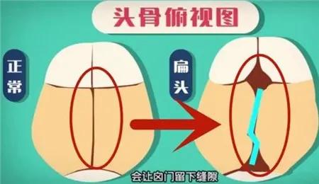 老人睡扁头是怎么回事,为什么老人非要给孩子睡扁头