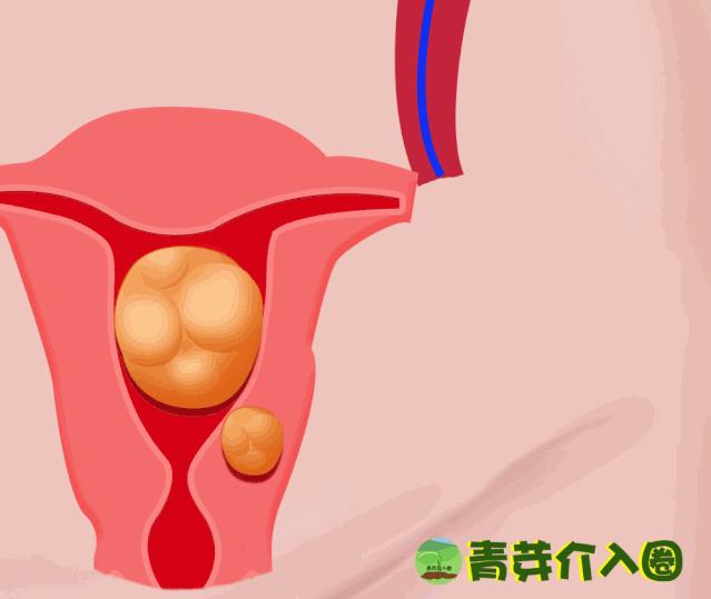 子宫肌瘤介入术动画,子宫肌瘤介入治疗动画演示