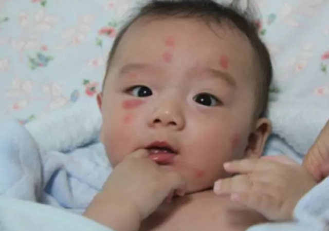 宝宝被蚊虫叮咬如何快速止痒消肿,宝宝被蚊虫叮咬后起大包怎么弄