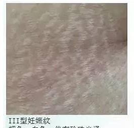 妊娠纹怎么消除才最快最有效,如何快速消除妊娠纹的有效方法