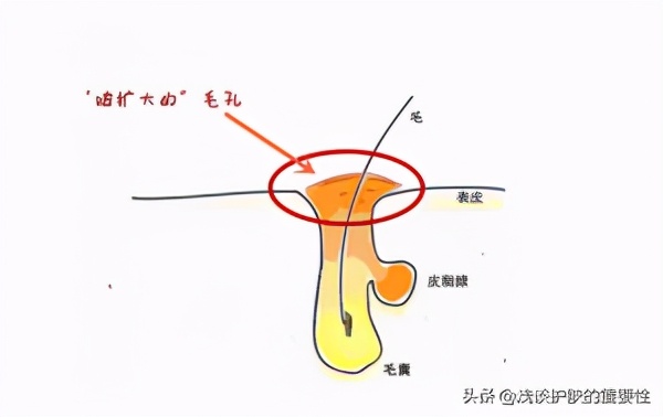 鼻子脸上毛孔粗大怎么收缩毛孔,鼻子旁边毛孔大如何收缩毛孔