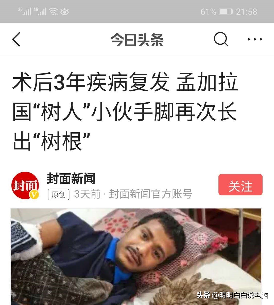 一招处理瘊子,无公害处理瘊子