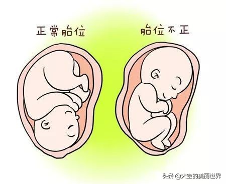 39周胎位不正能转过来吗,孕期胎位不正准妈妈莫慌张