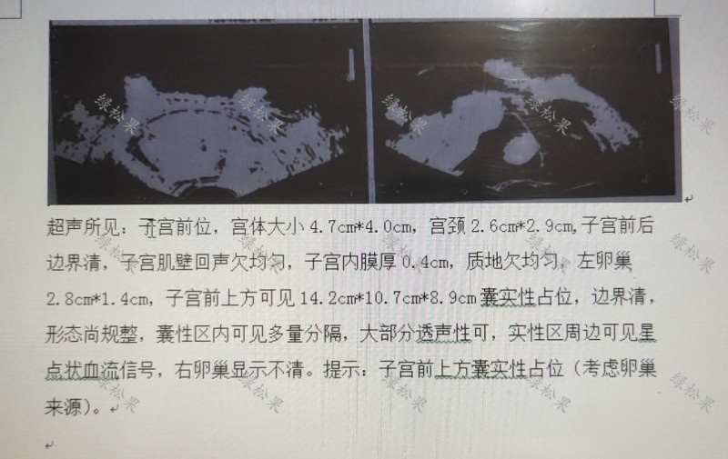患者女46岁1年前发现盆腔肿物,盆腔肿物卵巢癌