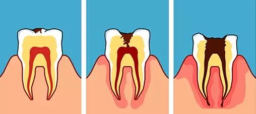 牙龈反复鼓包流脓是牙齿坏了吗,一上火牙龈就鼓包
