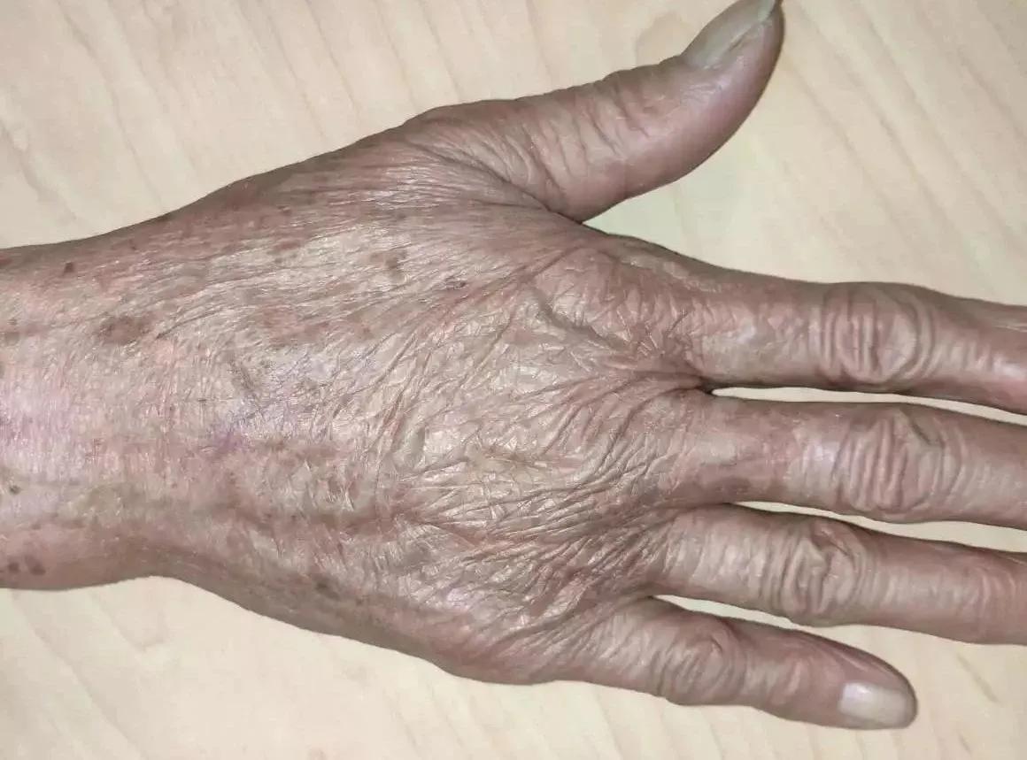 挤痘痘可引起败血症吗,挤痘痘引发的颅内感染能自己好吗