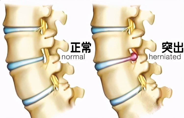 说说腰椎间盘突出症的那些事