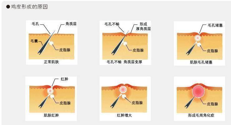 脸上有个光滑不痛不痒的小疙瘩,脸上皮肤粗糙长疙瘩是怎么回事