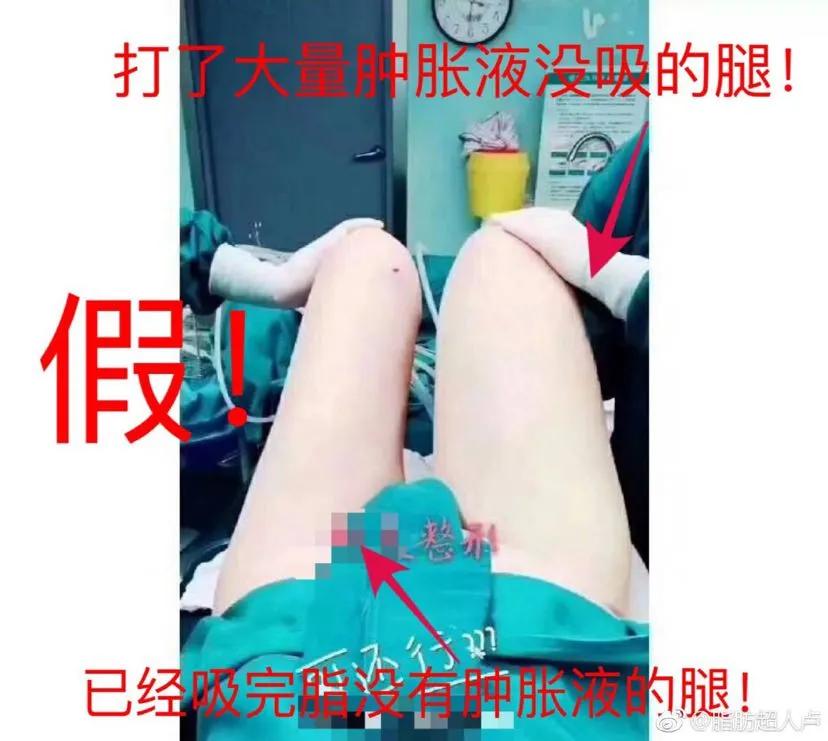 吸脂后腰部有积液抽一次,腰部吸脂一个月还有积液