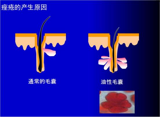 浠欎汉鎺岀棙鑲屼慨鎶よ啅,鐪嬪畬鐥樼棙浠ュ悗鎰熻鏇翠弗閲嶄簡