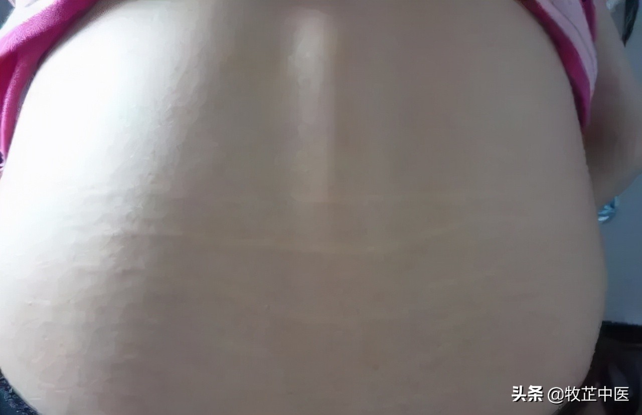 肾虚纹图片,肾虚纹真的有效果吗