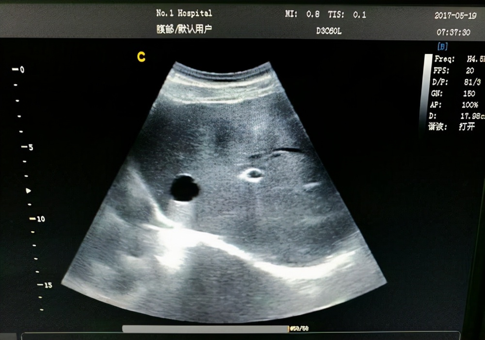 体检时检查出这六种病不必在意,体检查出这4种病一般不用治