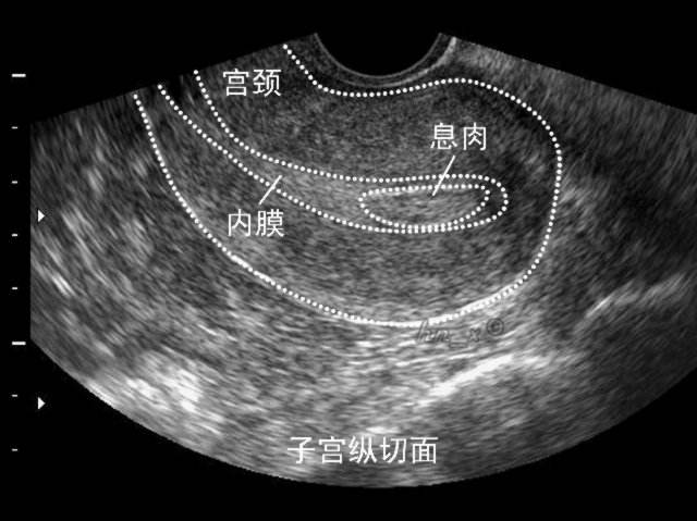 哪来的那么多“内膜增厚”