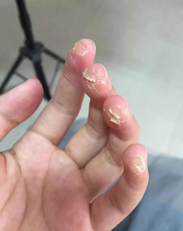 再继续这样弹琴,你的手就要“烂了”