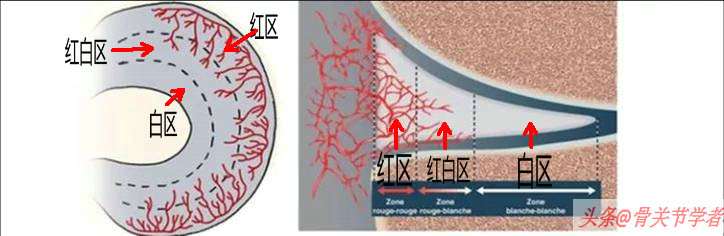 磁共振检查半月板损伤有误诊率吗,半月板磁共振会不会有误诊