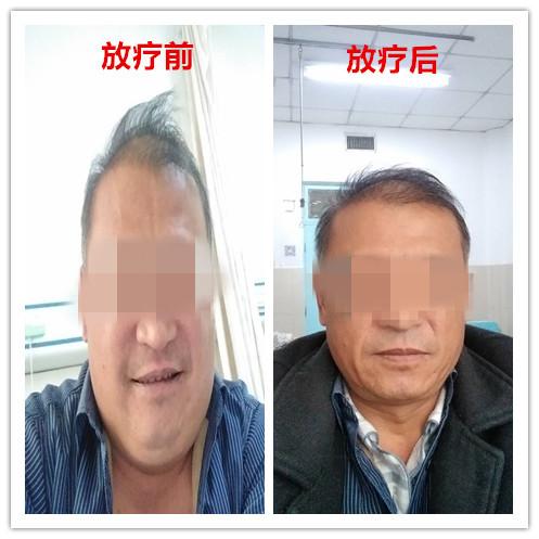 肿瘤患者化疗后体重增加了,肿瘤病人术后康复体重上升好吗