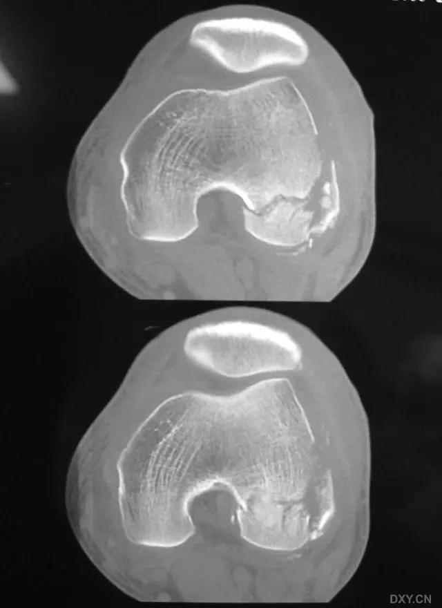 几种严重骨折医学名称,常见的骨折有哪些名称