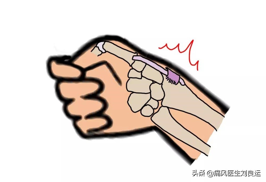 痛风引发腱鞘炎,痛风长出痛风石了怎么办