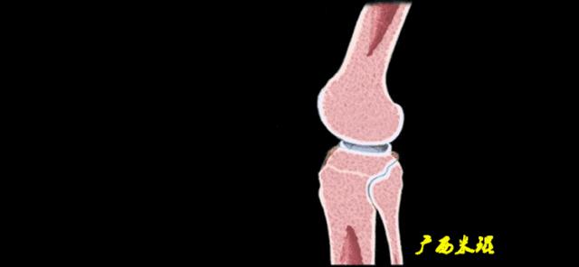 有关半月板的疾病与治疗,听骨科医生讲的话
