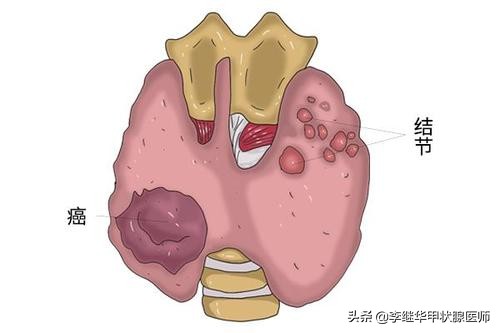 甲状腺结节4a良与恶性预后评估,甲状腺结节4a怎么干预为好