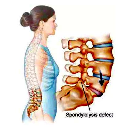 青少年脊柱弯曲危害科普视频,脊柱病科普小常识大全