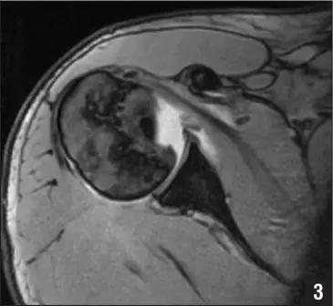 特殊骨折类型,特殊骨折体征