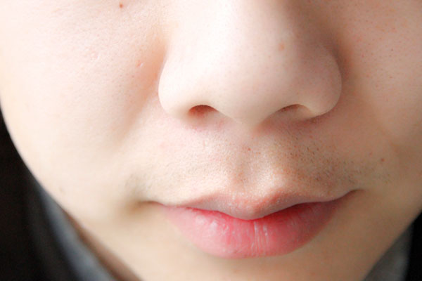 鼻翼两侧挤出白色东西怎么去除,鼻翼两侧有白色酸臭的东西是什么