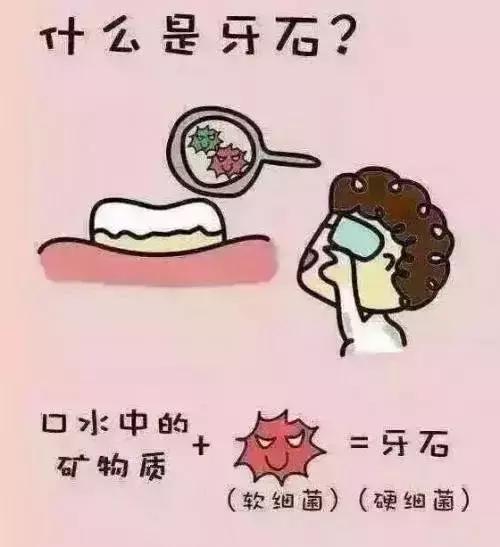 牙科不告诉你去牙结石的秘密,牙结石科普