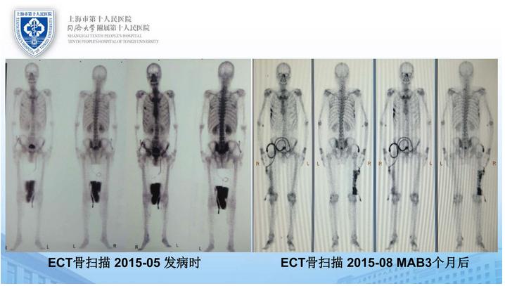 一例“超级复杂”T4期前列腺癌的手术治疗