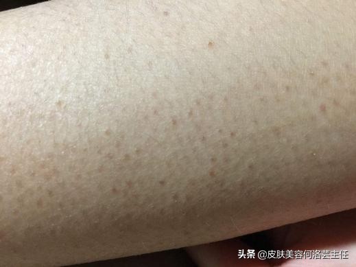 摆脱鸡皮肤的困扰,去鸡皮肤有效的方法真实测评