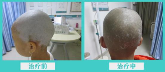 儿童初发白斑的治愈率,白斑早期有啥征兆