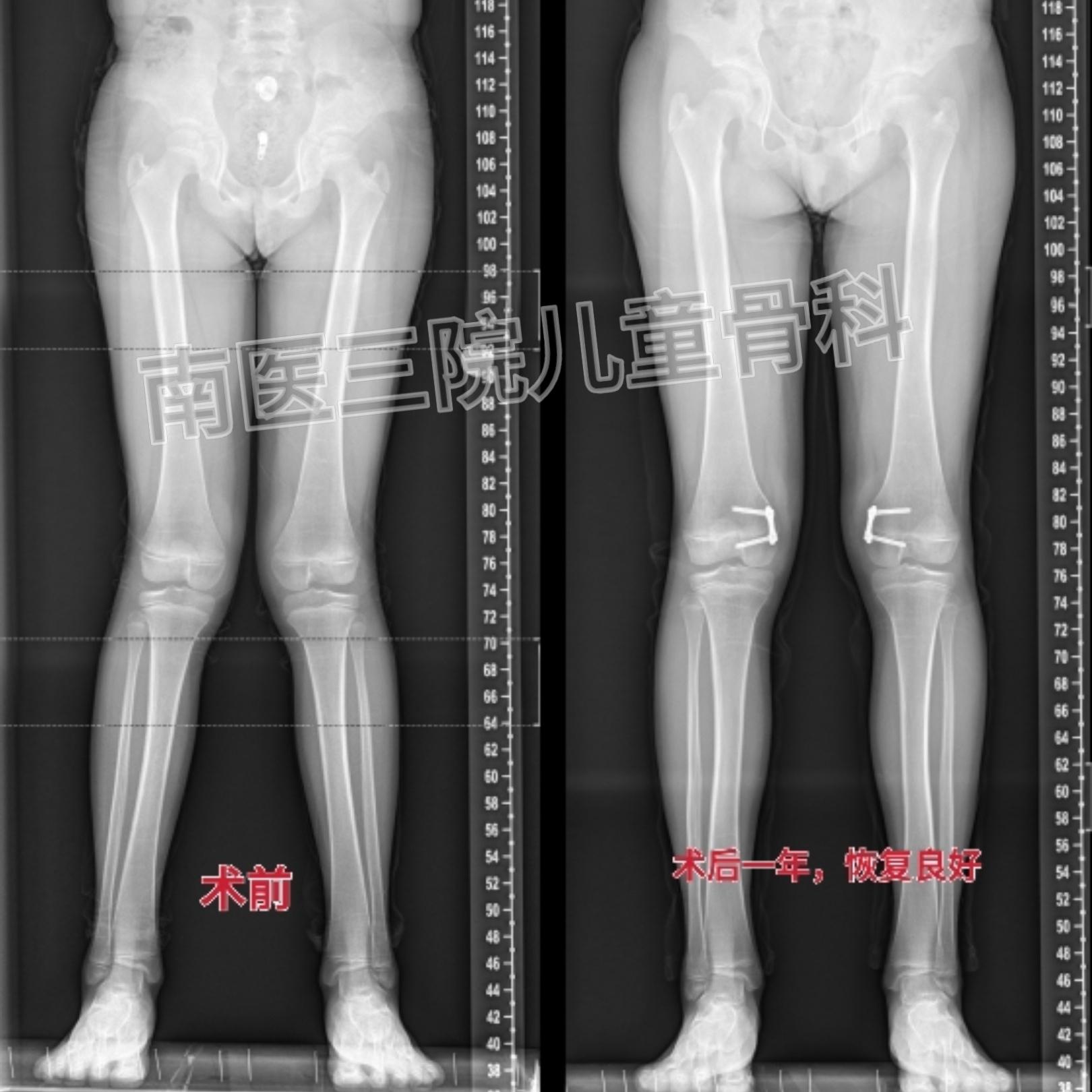宝宝有点x型腿,宝宝有点x型腿适合穿什么裤子