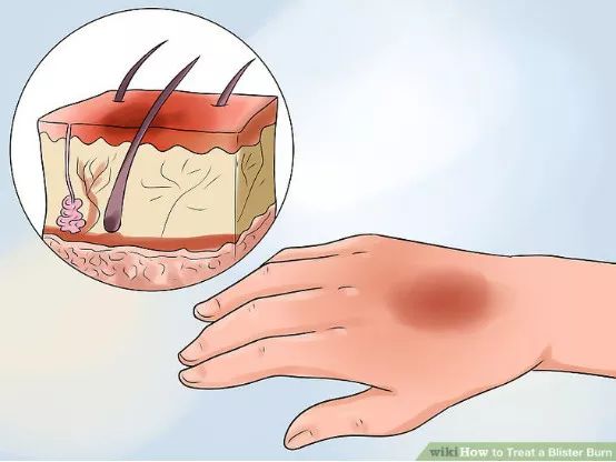 如何预防与处理比跑步膝痛还烦人的水泡？