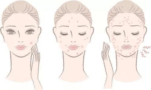 青少年长痘严重的原因,青春期长痘对心理影响