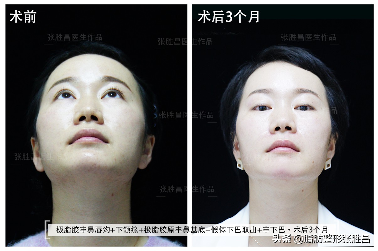 假体下巴手术亲身分享,做了假体下巴后成地包天