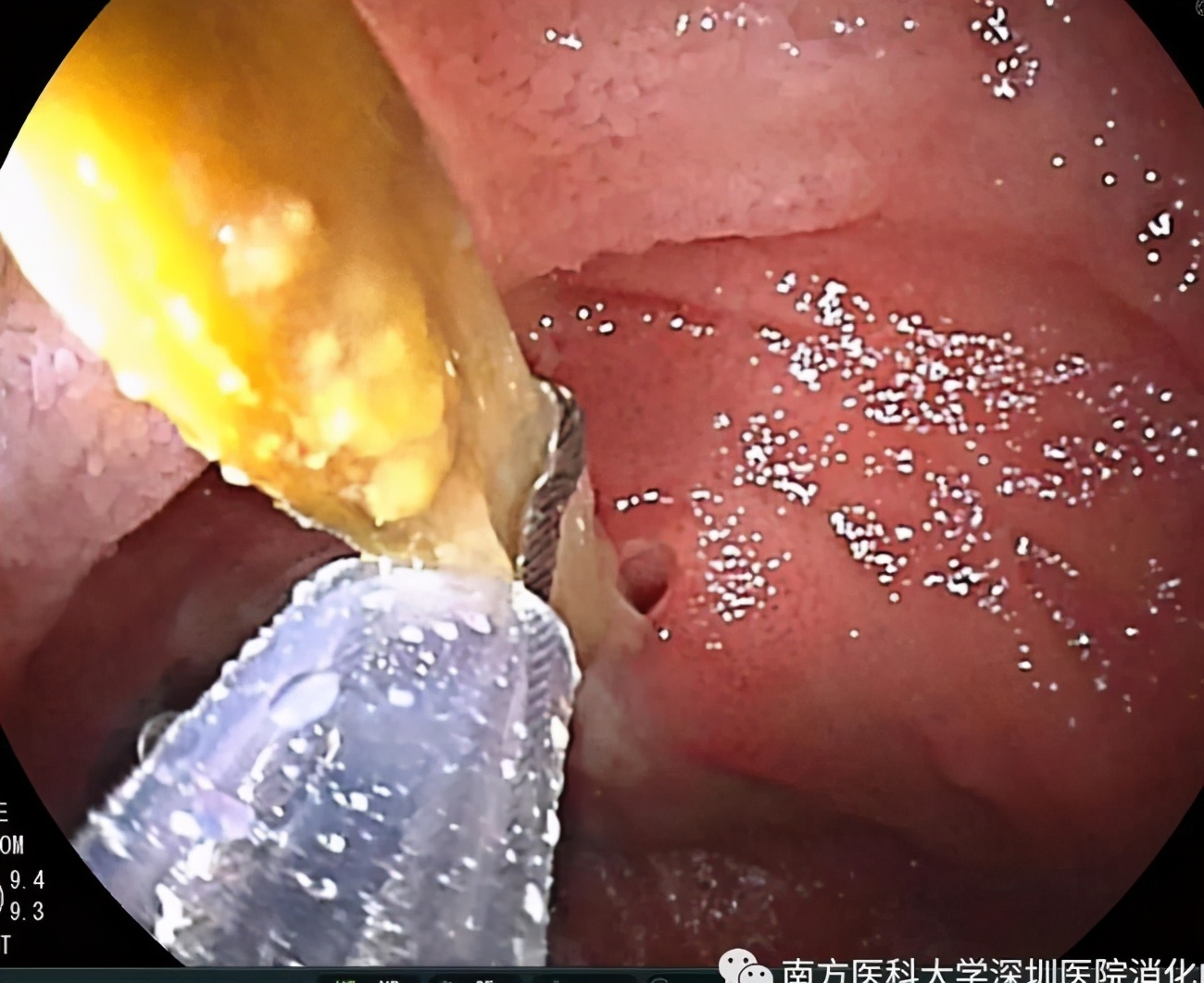 小肠异物取出手术步骤,小肠异物穿孔微创手术