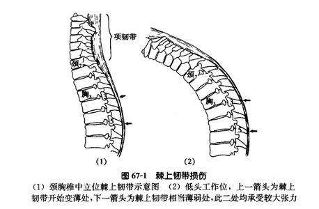 辟谣：后背疼痛是心脏病？骨科医生说上班族高发这个病，3招治好